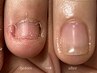 ハンド【深爪育成・自爪育成】最適な施術をご提案します◎