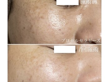 テテメルティ(te-te melty)/プロセルフェイシャル