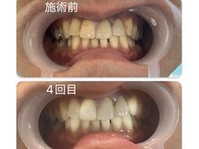 スマイルホワイト/40代男性