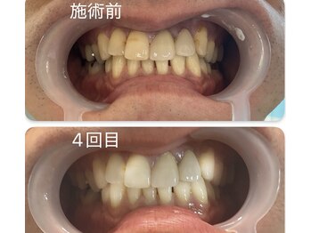 スマイルホワイト/40代男性