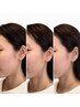 【エラ張り解消!】エラ矯正/小顔/エラ張り/フェイスライン◎7700円→4950円