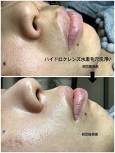 メディカルサロンドオフ 堺東店(medical salon de off)/水素毛穴洗浄♪