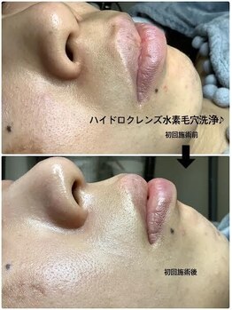 メディカルサロンドオフ 堺東店(medical salon de off)/水素毛穴洗浄♪