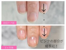 ルシェルアイ/【深爪・チビ爪】でお悩みの方