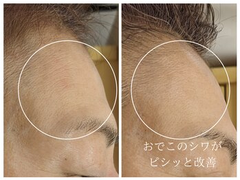 ラミーユ(La Miu)/エレサス(palupalu)エステコース