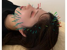 アロエベル(aloe Belle)/美容鍼