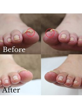 【巻き爪矯正】3回目