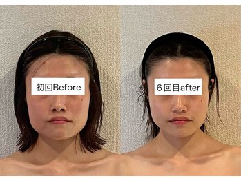 ミベル(MeBell)/小顔矯正/小顔コルギ