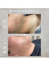 シック 南風原店(Chic)/20代　7ヶ月後の経過写真