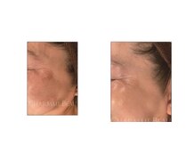 アティロン(Attirant)/【シミ肌改善プログラム】