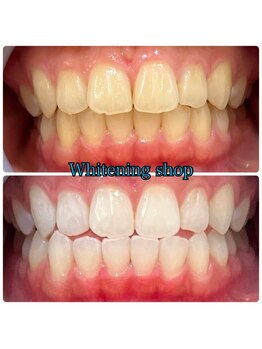 ホワイトニングショップ 大阪玉造店/Before&After美白ホワイトニング