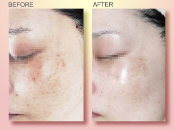 ジュリア オージェ 天王寺店/ビフォーアフター（シミケアP）