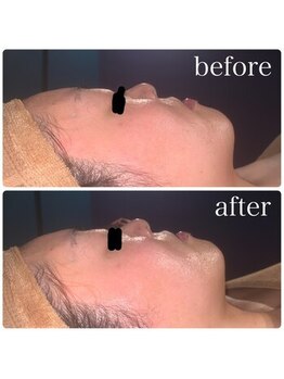 ベルフルール 西18丁目店/ハーブピーリング×韓国コルギ