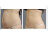 【お腹の脂肪が気になる方に◎】気になる部位に最新痩身◆脂肪冷却◆《お腹》