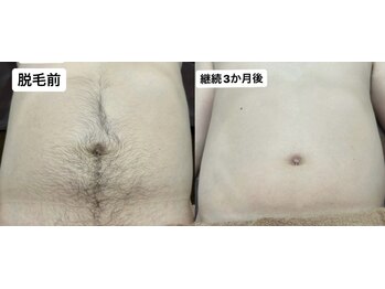 アカラ 読谷店(AKALA)/全身脱毛