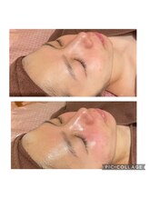 エステテックサロンラレーヌ 小山店(La Reine)/韓国ツヤ肌で自然なツヤを☆