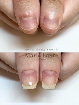 マリーロール 梅田店(Marie Laure)/深爪矯正/自爪育成/自爪風