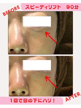 ユーフォリア(Euphoria)/スピーディリフトでも効果実感