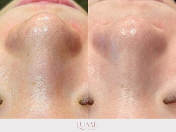 ルーミー 南青山(LUME)/毛穴の引き締め／ピーリング