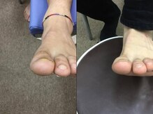 【巻き爪/深爪/フットケア】巻き爪本舗　津田沼店/陥入爪も矯正可能です！