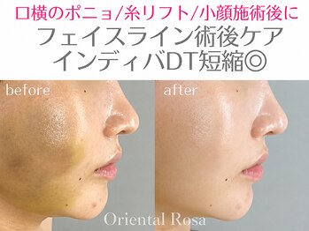 オリエンタルローザ 表参道(Oriental Rosa)/糸リフト術後アフターケアケア◎