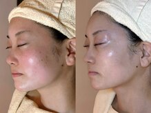キュー(qu')の雰囲気（ニキビ、毛穴にお悩みの方はトロイアルケの根本改善ケアを◎）