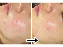 おうちサロン ミキ/3種類のピーリングでお肌改善