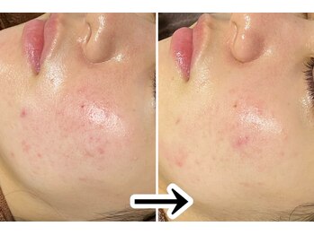 おうちサロン ミキ/3種類のピーリングでお肌改善