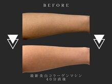 スア(SUA)/美白コラーゲンマシン40分の効果