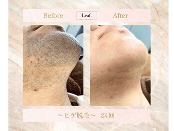 リーフ(Leaf.)/ひげ脱毛
