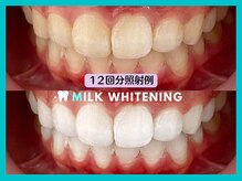 ミルクホワイトニング 長崎中央橋店(Milkホワイトニング)/◆施術例