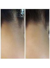 キアラ 麻布十番(Kiara)/うなじ脱毛麻布十番/毛穴/顔脱毛