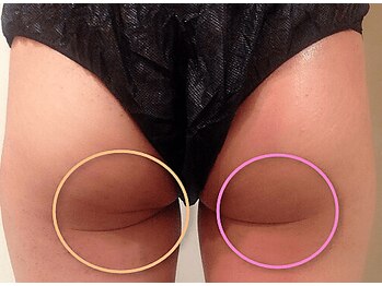 ラグラン銀座メディカルエステ 高輪ゲートウェイ店/セルマジ温吸引頑固な脂肪細胞に