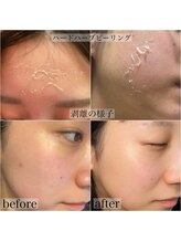 アリクシー(ALIXSY)/ハードハーブピーリング◎