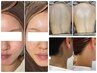【うなじ&背上脱毛&フェイシャル】3ヶ月コース91,000円→49,800円★