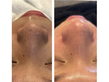 スムース イー(Smooth+E)/学割毛穴脱毛おすすめセット！