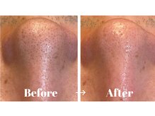 カラーリリー アンド ユン(Calla lily & yun)/ハイドラ毛穴洗浄でスッキリ！