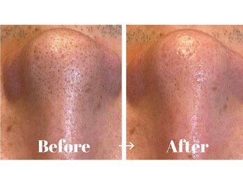 カラーリリー アンド ユン(Calla lily & yun)/ハイドラ毛穴洗浄でスッキリ！