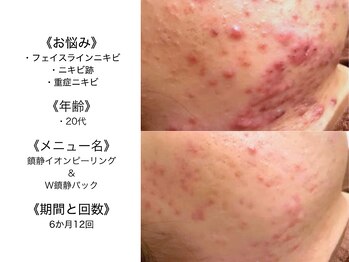 アクール(Accueil)/毛穴ケア/肌質改善/ニキビケア