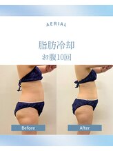 エアリアル 武雄店/脂肪冷却