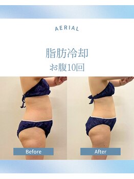 エアリアル 武雄店/脂肪冷却