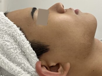 ウェクシー 名古屋駅前店(WECXII)/凹んだ跡も改善