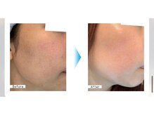 光フェイシャル　3回