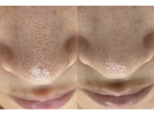 サロン ド リアン(Salon de Lien)/【毛穴ケア】当店人気メニュー