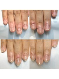 ピンク部分か健康な縦長爪に!!