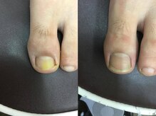 【巻き爪/深爪/フットケア】巻き爪本舗　津田沼店/深爪も矯正OK