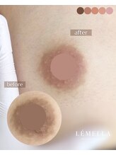 エルビービュティーサロン(LB BEAUTY SALON)/【ルメラ乳輪】実績数関西1★