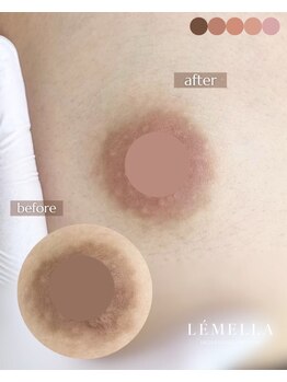エルビービュティーサロン(LB BEAUTY SALON)/【ルメラ乳輪】実績数関西1★