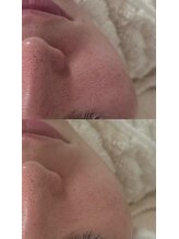 ナチュリー(Naturry)/毛穴の開き改善