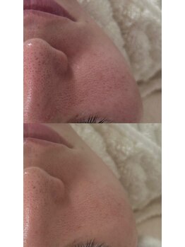 ナチュリー(Naturry)/毛穴の開き改善